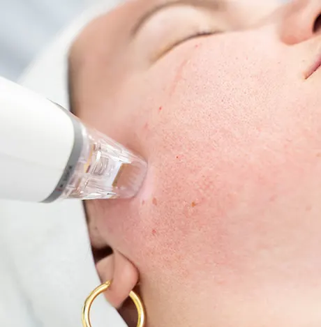 radiofrequency-microneedling-treatment
