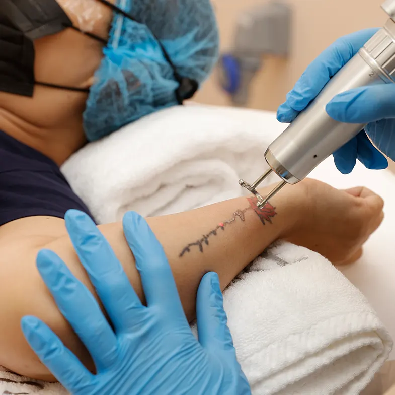 tattoo-removing