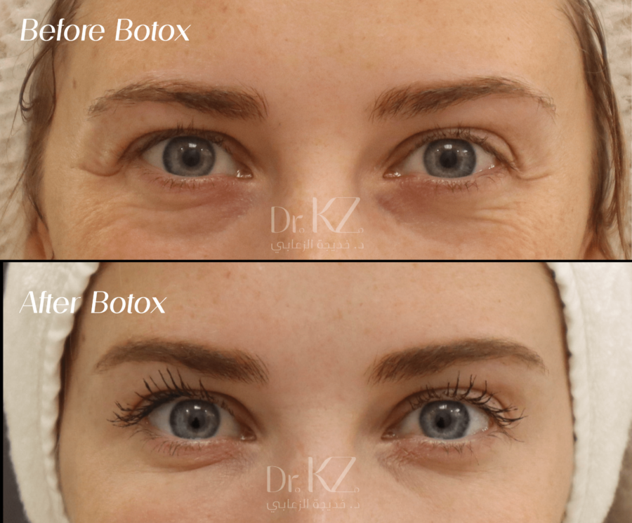 Botox Treatment Areas Botox injection areas including forehead lines, crow's feet, and frown lines treatment in Abu Dhabi