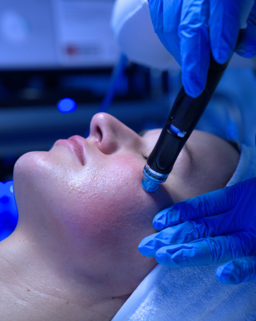 HydraFacial Extraction Process Painless Vortex-Extraction process during a HydraFacial in Abu Dhabi