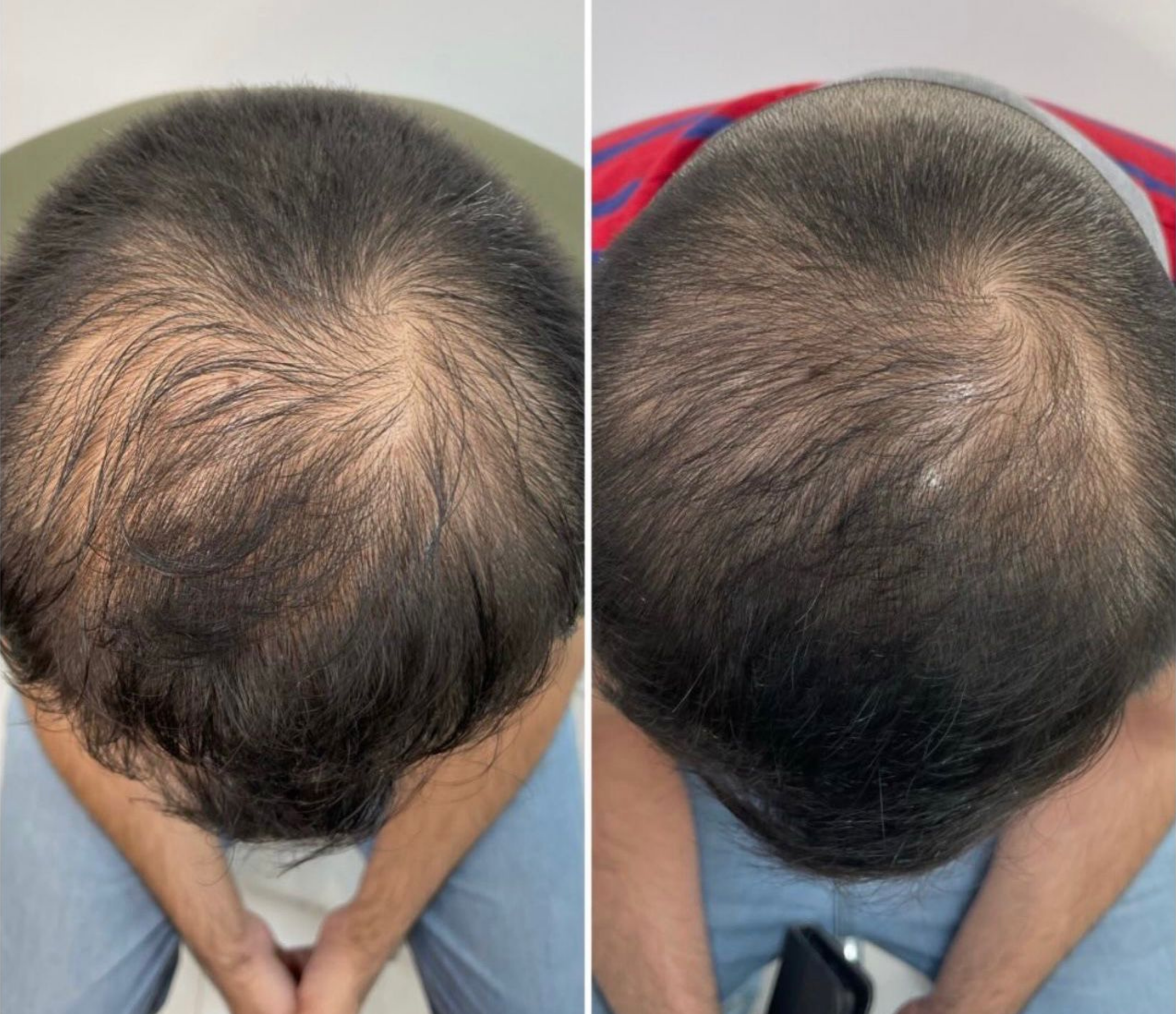 PRP for Hair Loss in Abu Dhabi: A Dermatologist's Guide Before and after PRP hair loss treatment results showing improved hair density at House of Skincare Abu Dhabi
