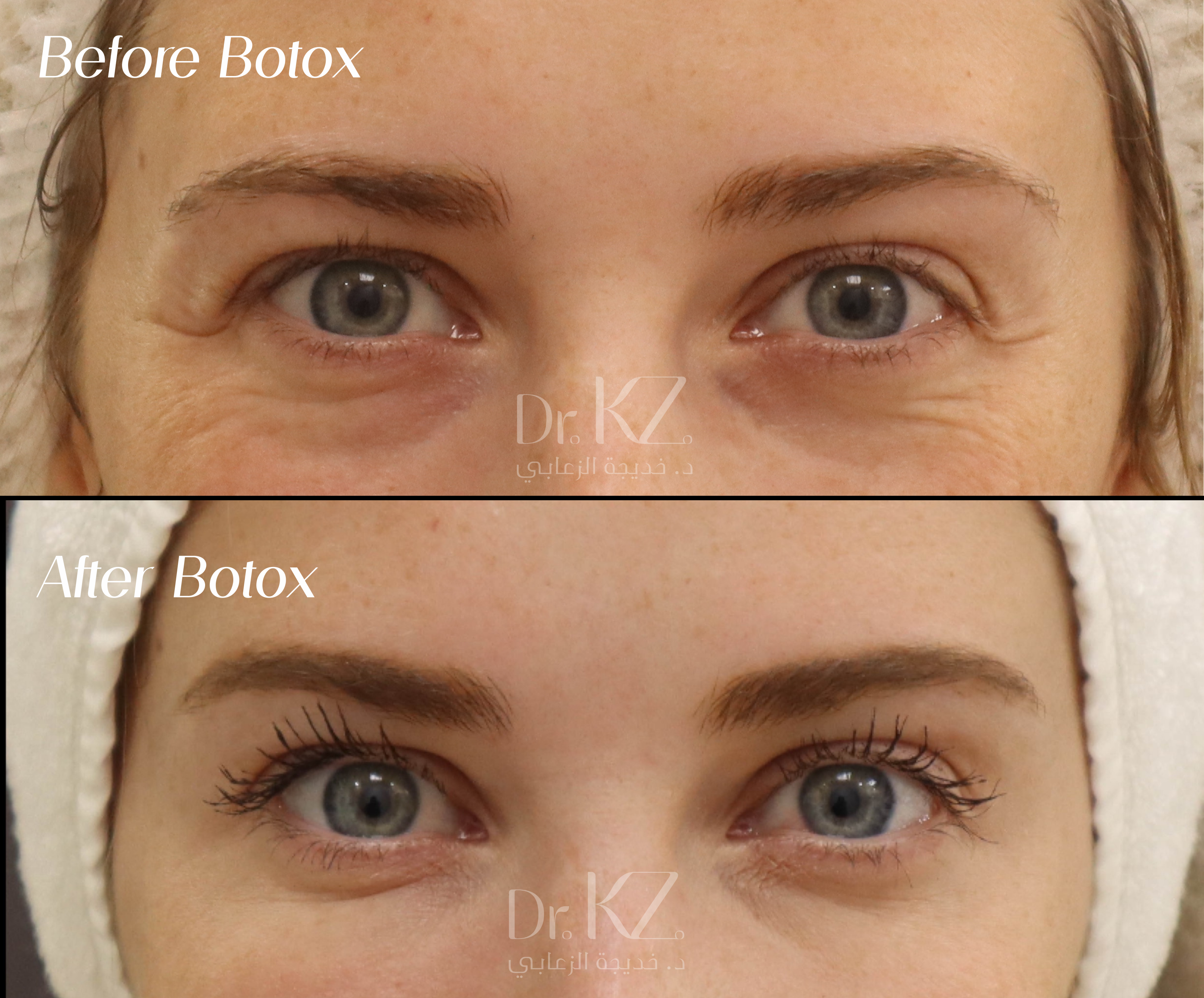 الدليل الشامل للبوتوكس والفيلر في أبوظبي نتائج بوتوكس طبيعية المظهر في أفضل عيادة بوتوكس في أبوظبي هاوس أوف سكينكير