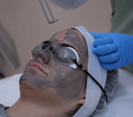 carbon laser house of skincare