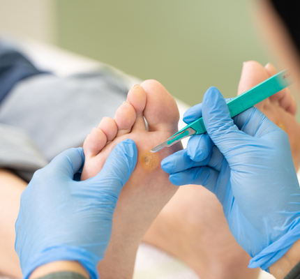 stubborn_wart_treatment_Abu_Dhabi