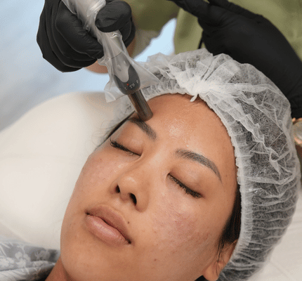 Microneedling Treatment Abu Dhabi — Dermapen at House of Skincare Microneedling treatment Abu Dhabi — Dermapen skin rejuvenation