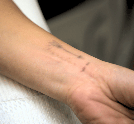 Painless Tattoo Removal Abu Dhabi — Laser Treatment at House of Skincare Painless tattoo removal Abu Dhabi — laser tattoo removal clinic